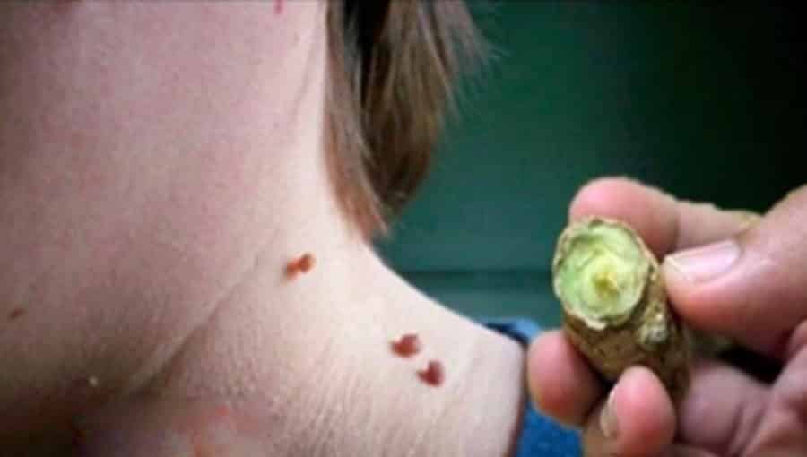 Combate verrugas, manchas e espinhas com produtos naturais
